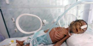 เหลียวมอง สถานการณ์แห่งความหายนะของเด็กเยเมนในเงามืดของสงครามที่ถูกลืม